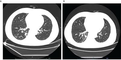 A pulmonary enteric adenocarcinoma patient harboring a rare EGFR exon 19 P753S mutation: Case report and review